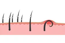 Kıl Dönmesi Apsesi Belirtileri ve Tedavisi