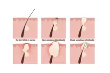 Makatta Kıl Dönmesi Belirtileri ve Tedavisi