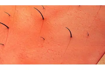 Vajinada Kıl Dönmesi Belirtileri ve Tedavisi