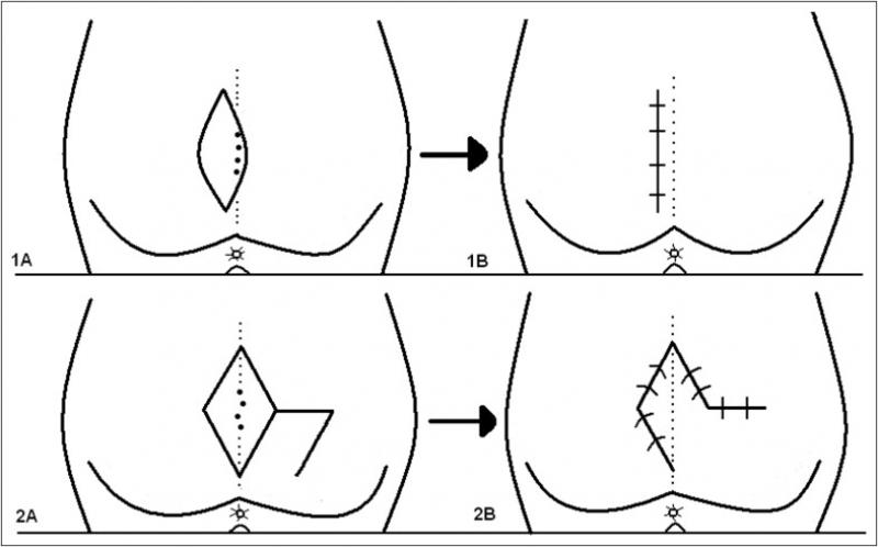 Kıl Dönmesi Flap Yönteminin Faydaları Nelerdir?
